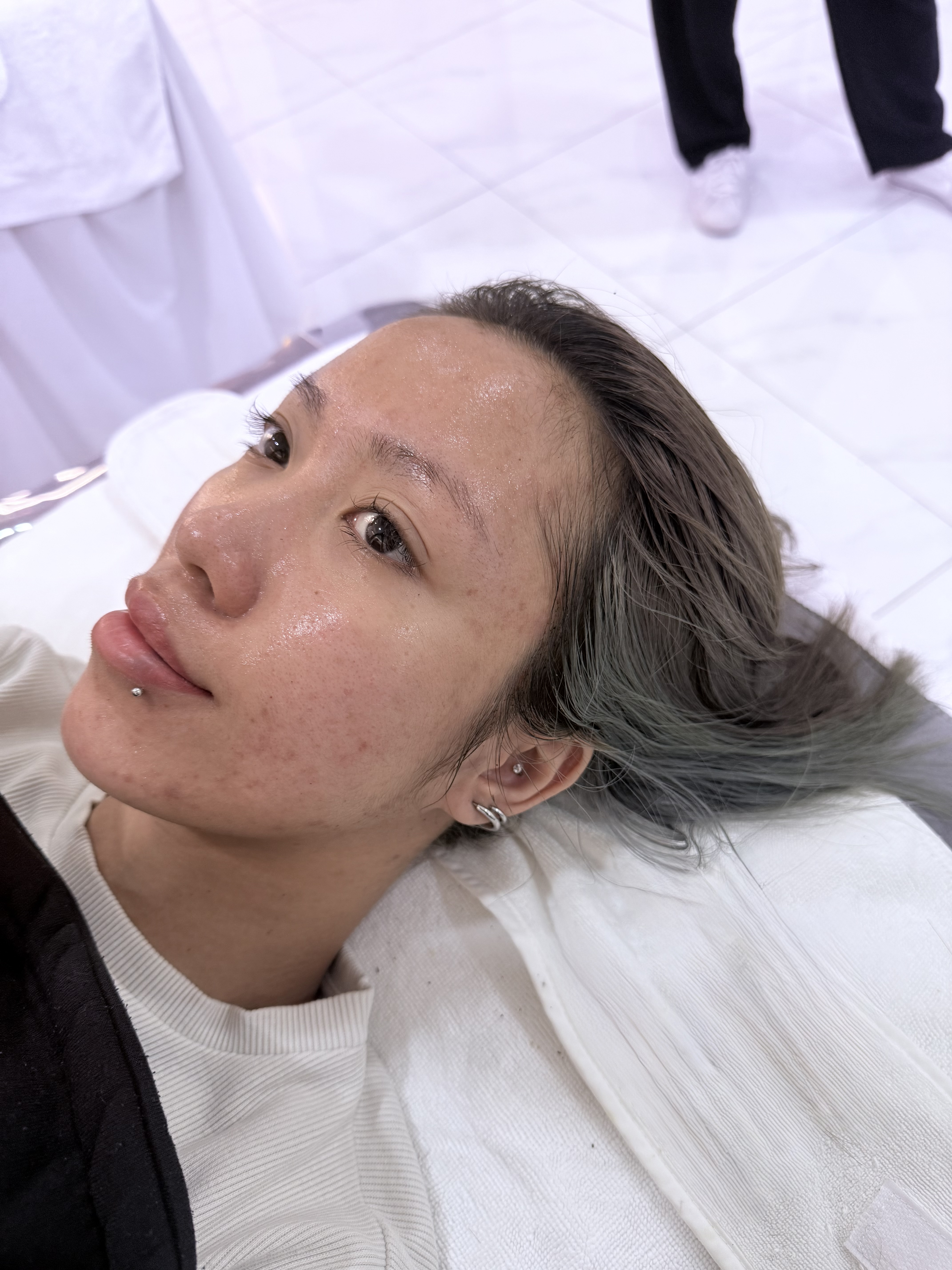 Trị mụn chuẩn y khoa